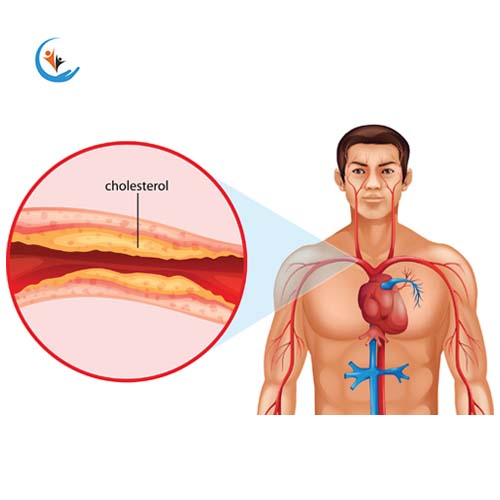 Cholesterol