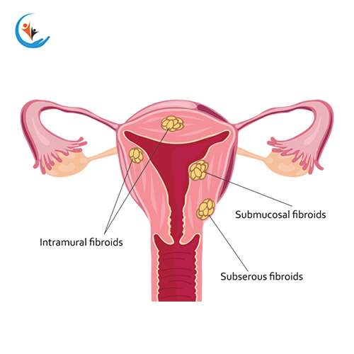 Fibroids