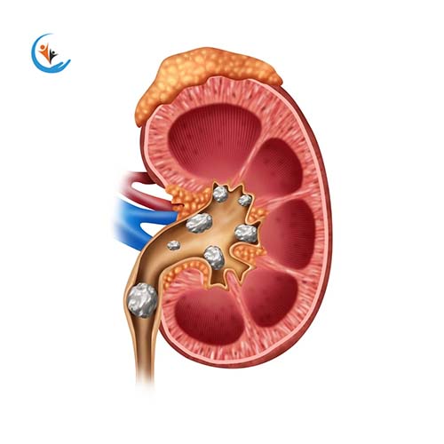 Kidney Disease