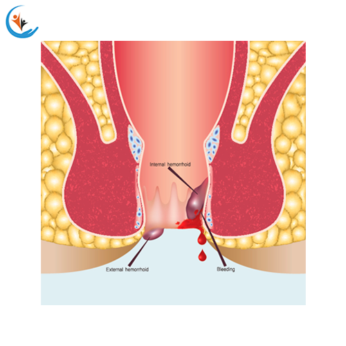 Piles Fissure Fistula