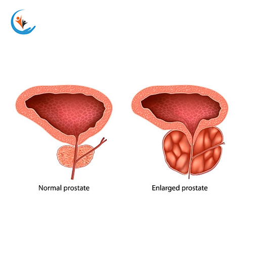 Prostate Problem