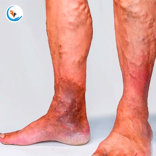 Varicose Veins